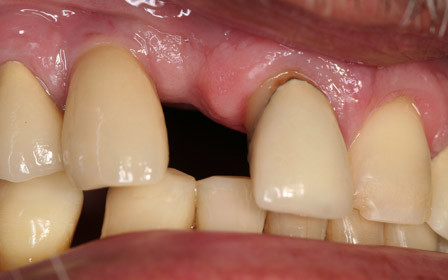 Before treatment
