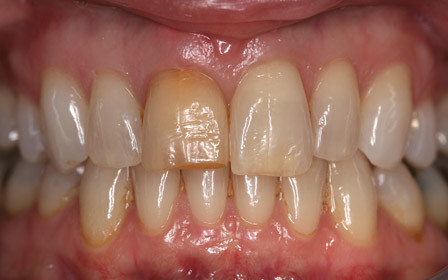 Before treatment