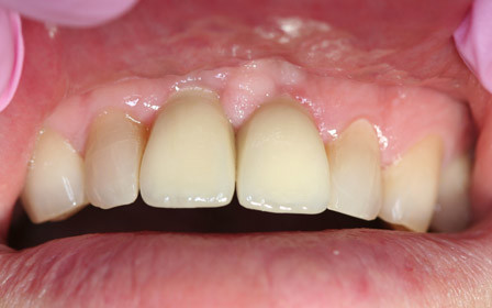After treatment