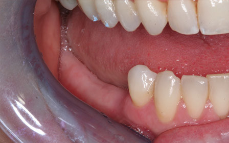 Before treatment