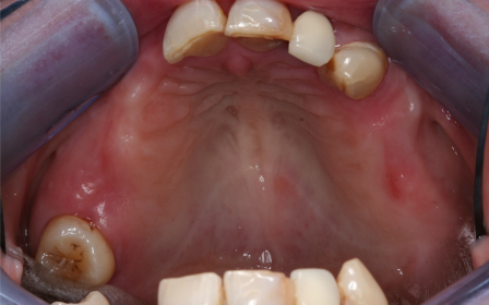 Implants Before