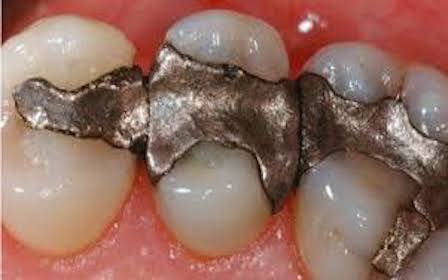 What’s wrong with amalgam fillings?